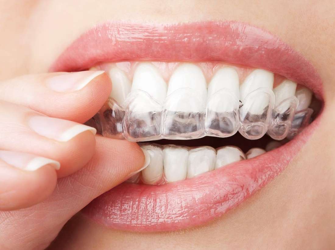 Invisalign Tracking Why Aren’t My Teeth Moving? Invisalign Clear Braces Raleigh NC