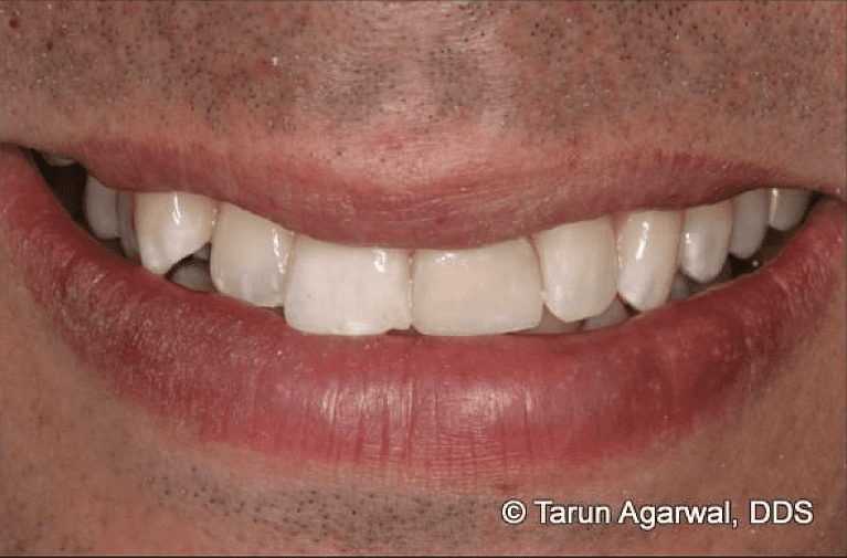 Cosmetic-Bonding-After-Image