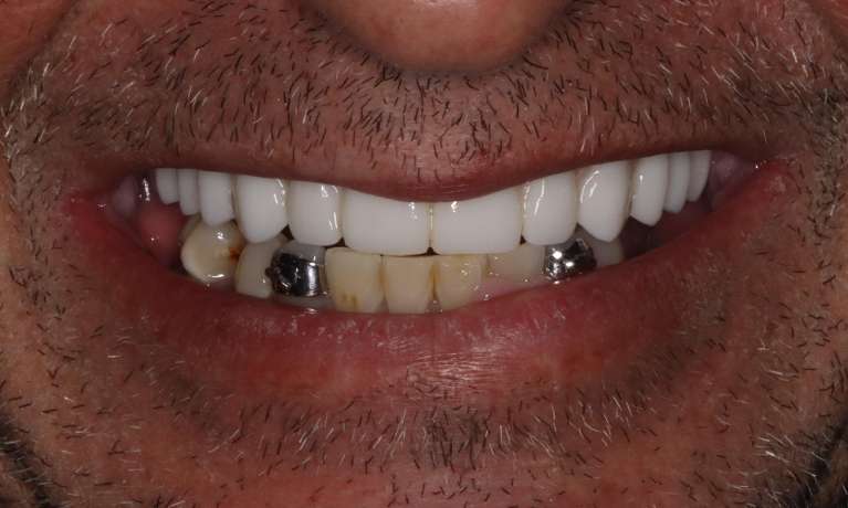 David-s-Smile-Transformation-with-Hybrid-Dentures-and-Dental-Implants-After-Image