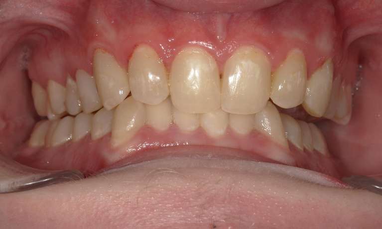 From-Soda-Stains-to-a-Confident-Smile-After-Image