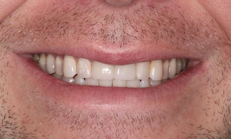 Jeff-s-Smile-Transformation-Restoring-Confidence-After-an-Accident-After-Image
