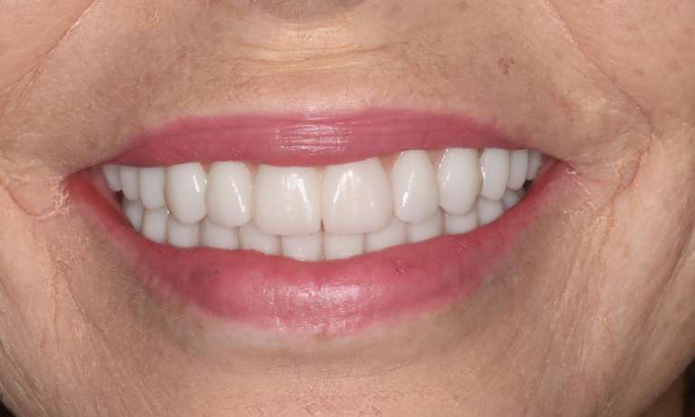 Melissa-s-Journey-to-a-Healthier-Youthful-Smile-with-Hybrid-Dentures-After-Image