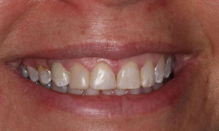 Transforming-a-Smile-and-Easing-Dental-Anxiety-After-Image