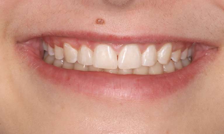 Boosting-Confidence-with-Cosmetic-Bonding-After-Orthodontics-After-Image