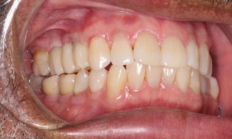 Regaining-Health-and-Function-with-Dental-Implants-After-Image