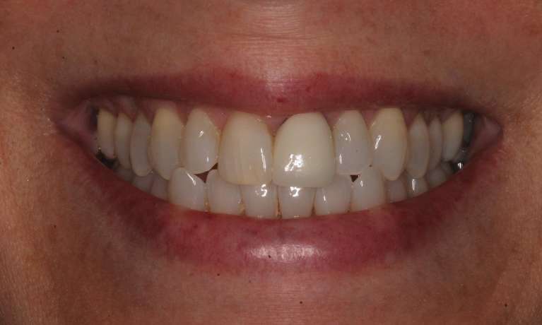 A-Seamless-Smile-Audrey-s-Single-Front-Tooth-Crown-Replacement-Before-Image