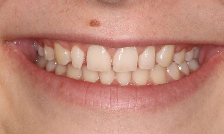 Boosting-Confidence-with-Cosmetic-Bonding-After-Orthodontics-Before-Image