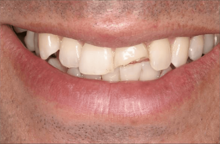 Cosmetic-Bonding-Before-Image