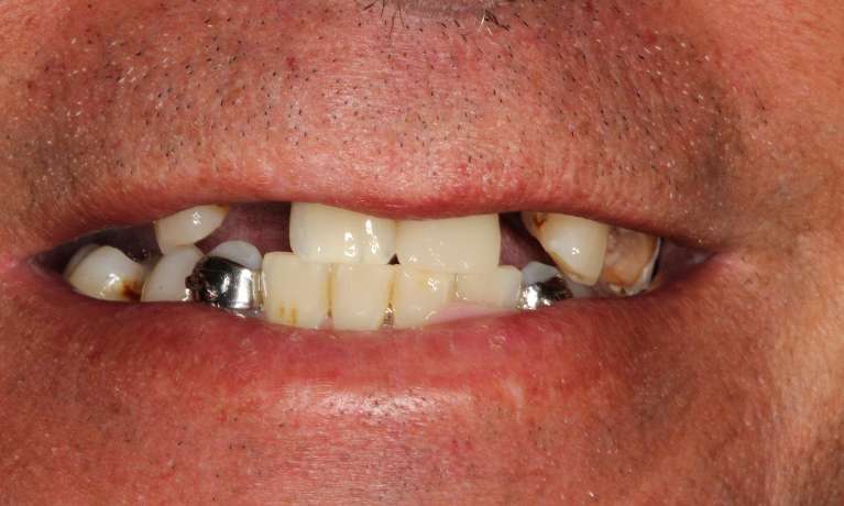 David-s-Smile-Transformation-with-Hybrid-Dentures-and-Dental-Implants-Before-Image