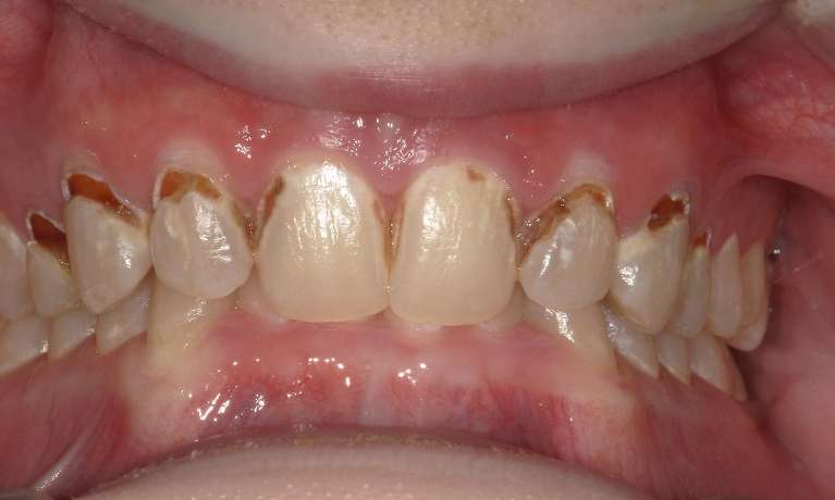 From-Soda-Stains-to-a-Confident-Smile-Before-Image