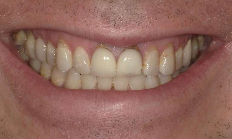 Jeff-s-Smile-Transformation-Restoring-Confidence-After-an-Accident-Before-Image
