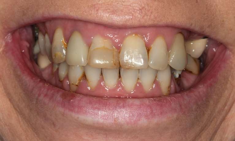 Melissa-s-Journey-to-a-Healthier-Youthful-Smile-with-Hybrid-Dentures-Before-Image
