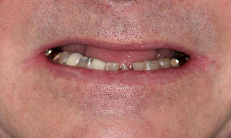 Mike-s-Transformation-with-All-on-X-Hybrid-Dentures-Before-Image