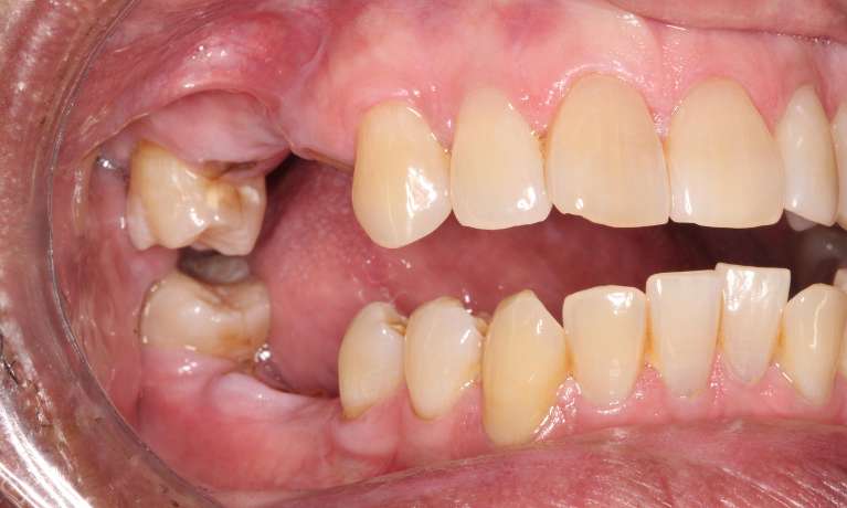 Regaining-Health-and-Function-with-Dental-Implants-Before-Image