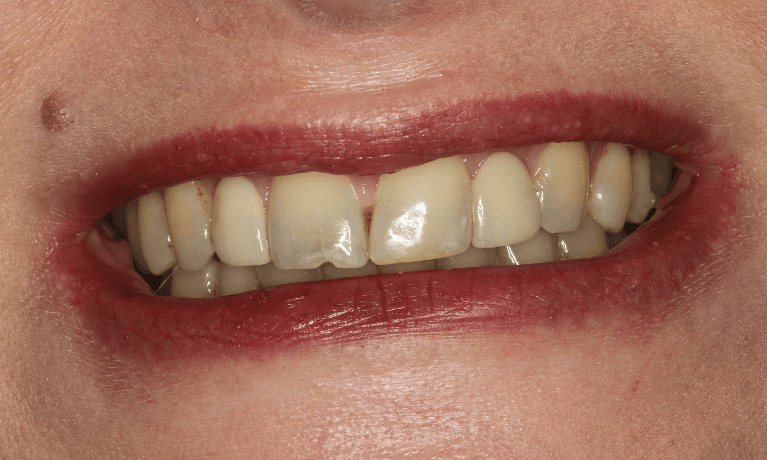 Restoring-Jill-s-Confidence-A-Smile-Makeover-Journey-Before-Image
