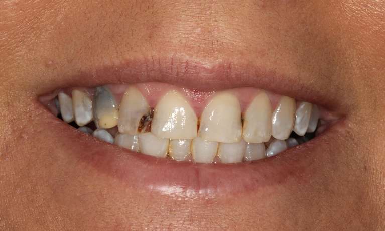 Transforming-a-Smile-and-Easing-Dental-Anxiety-Before-Image