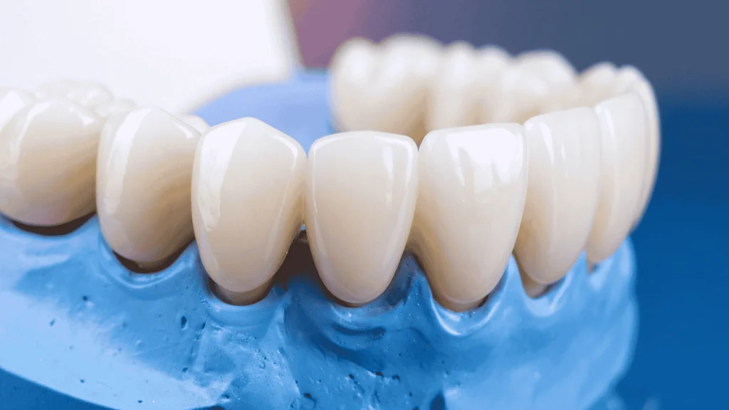 Dental Implant Cost Breakdown: What Actually Affects the Final Price? 3 Dental Bridges