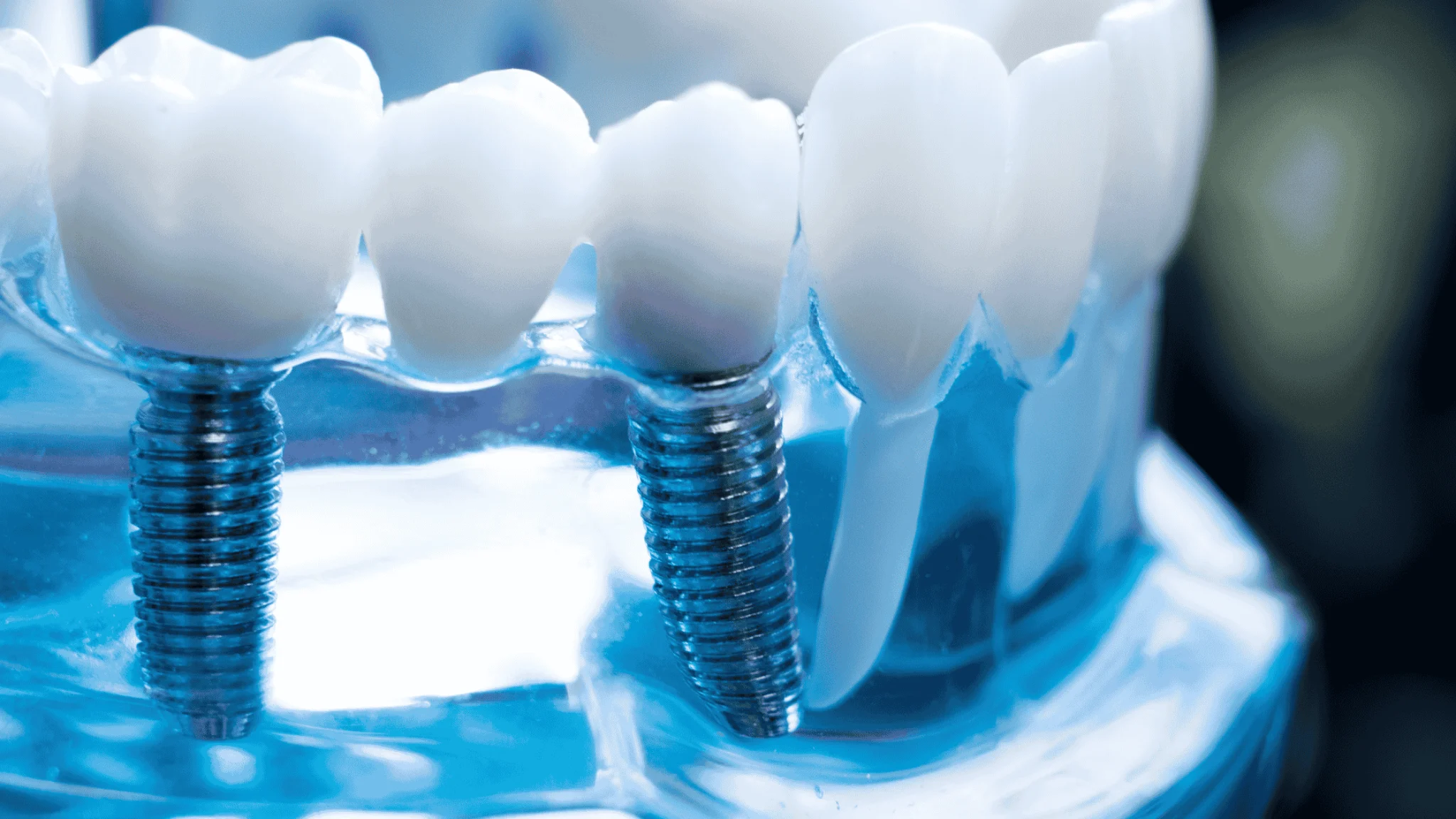 all on 4 vs traditional implants