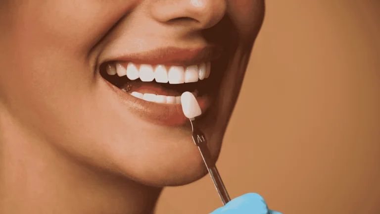 can you whiten teeth with veneers