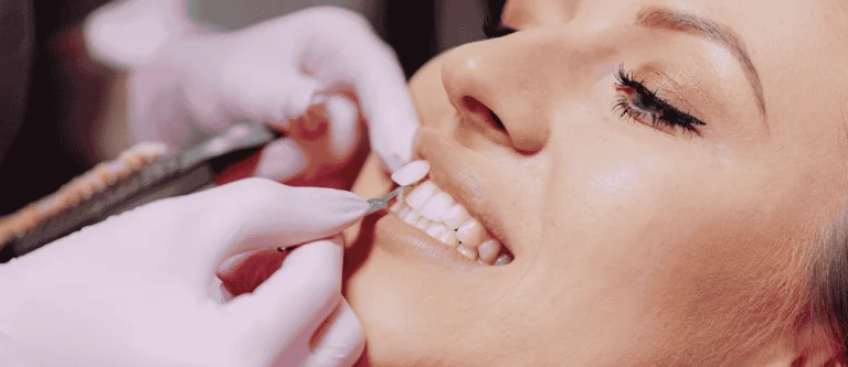 chipped veneer in Raleigh