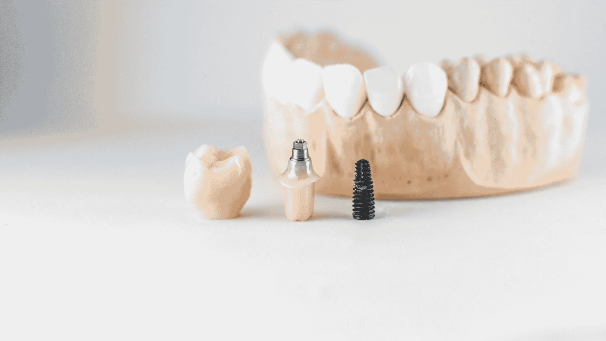dental implants and veneers together