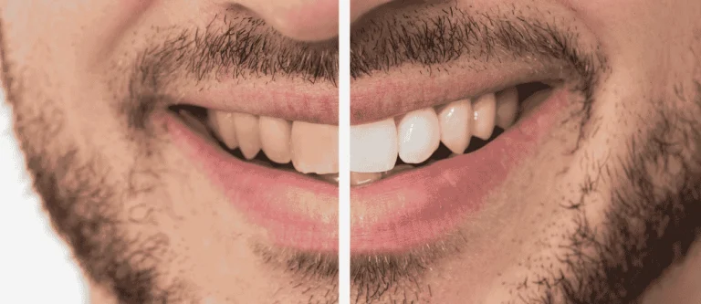 why teeth whitening isn't working